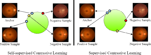Figure 1 for COROLLA: An Efficient Multi-Modality Fusion Framework with Supervised Contrastive Learning for Glaucoma Grading