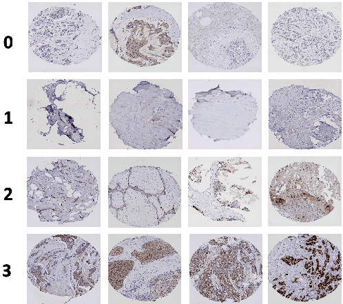 Figure 1 for Automatically Score Tissue Images Like a Pathologist by Transfer Learning