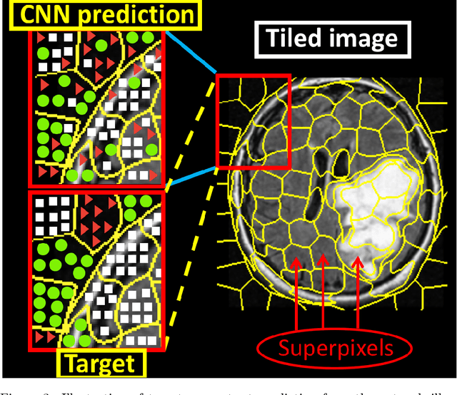 Figure 3 for Unsupervised deep clustering and reinforcement learning can accurately segment MRI brain tumors with very small training sets