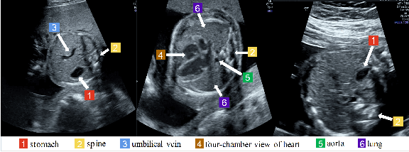 Figure 1 for Statistical Dependency Guided Contrastive Learning for Multiple Labeling in Prenatal Ultrasound