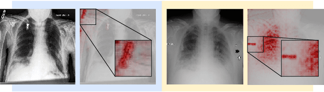 Figure 1 for Demonstrating The Risk of Imbalanced Datasets in Chest X-ray Image-based Diagnostics by Prototypical Relevance Propagation