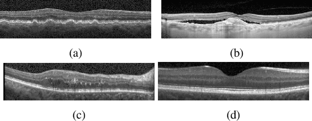 Figure 1 for Classification of dry age-related macular degeneration and diabetic macular edema from optical coherence tomography images using dictionary learning