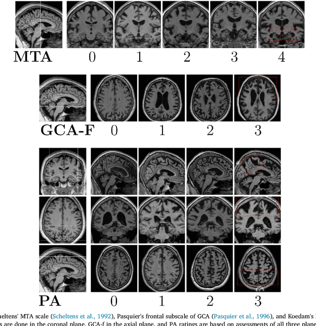 Figure 2 for AVRA: Automatic Visual Ratings of Atrophy from MRI images using Recurrent Convolutional Neural Networks