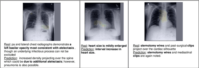 Figure 3 for Learning Visual-Semantic Embeddings for Reporting Abnormal Findings on Chest X-rays