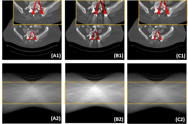 Figure 2 for DAN-Net: Dual-Domain Adaptive-Scaling Non-local Network for CT Metal Artifact Reduction