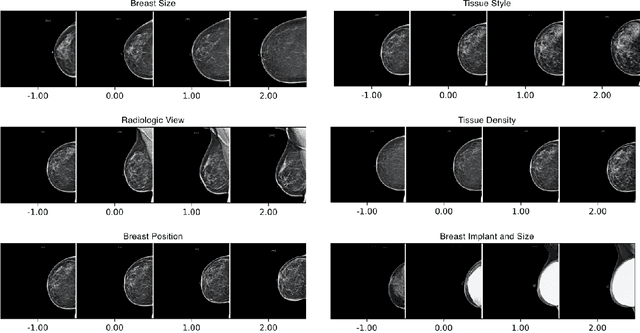 Figure 2 for MammoGANesis: Controlled Generation of High-Resolution Mammograms for Radiology Education