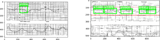 Figure 3 for Detection of preventable fetal distress during labor from scanned cardiotocogram tracings using deep learning