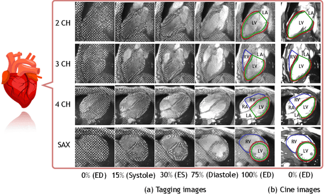 Figure 1 for DeepTag: An Unsupervised Deep Learning Method for Motion Tracking on Cardiac Tagging Magnetic Resonance Images