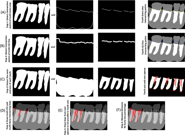 Figure 3 for An End-to-end Entangled Segmentation and Classification Convolutional Neural Network for Periodontitis Stage Grading from Periapical Radiographic Images