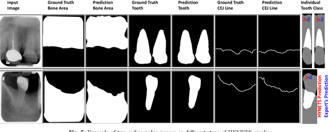 Figure 4 for An End-to-end Entangled Segmentation and Classification Convolutional Neural Network for Periodontitis Stage Grading from Periapical Radiographic Images