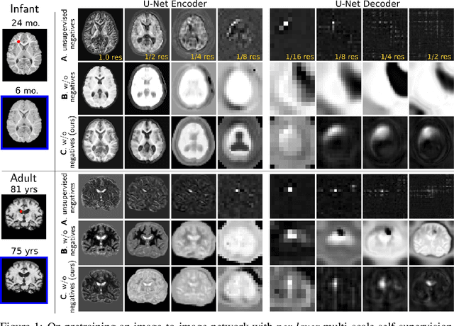 Figure 1 for Local Spatiotemporal Representation Learning for Longitudinally-consistent Neuroimage Analysis