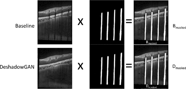 Figure 4 for DeshadowGAN: A Deep Learning Approach to Remove Shadows from Optical Coherence Tomography Images