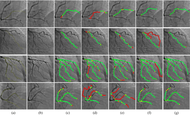 Figure 1 for Greedy Graph Searching for Vascular Tracking in Angiographic Image Sequences