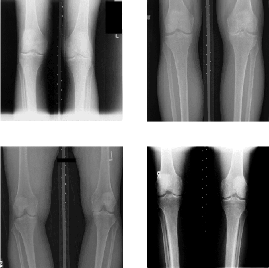 Figure 4 for Feature Learning to Automatically Assess Radiographic Knee Osteoarthritis Severity