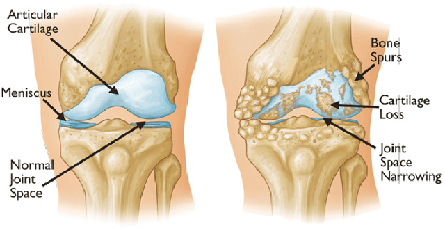 Figure 1 for Feature Learning to Automatically Assess Radiographic Knee Osteoarthritis Severity