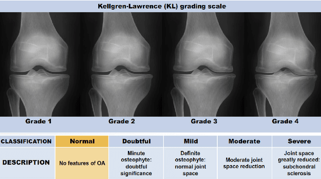 Figure 3 for Feature Learning to Automatically Assess Radiographic Knee Osteoarthritis Severity