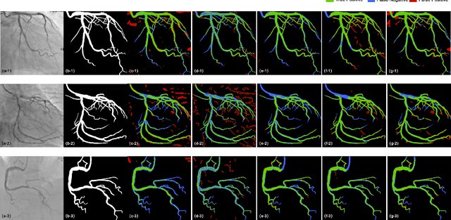 Figure 3 for Robust PCA Unrolling Network for Super-resolution Vessel Extraction in X-ray Coronary Angiography