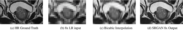 Figure 3 for Anisotropic Super Resolution in Prostate MRI using Super Resolution Generative Adversarial Networks