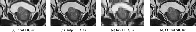 Figure 4 for Anisotropic Super Resolution in Prostate MRI using Super Resolution Generative Adversarial Networks