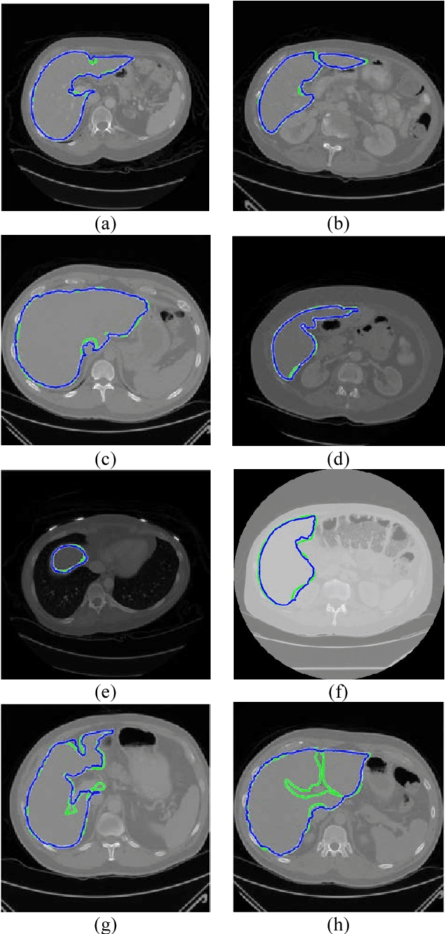 Figure 2 for Liver Segmentation in Abdominal CT Images by Adaptive 3D Region Growing