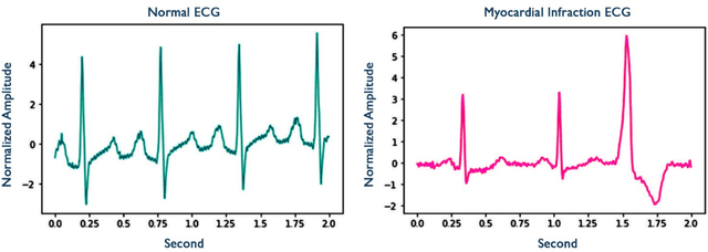 Figure 1 for A Survey of Applications of Artificial Intelligence for Myocardial Infarction Disease Diagnosis