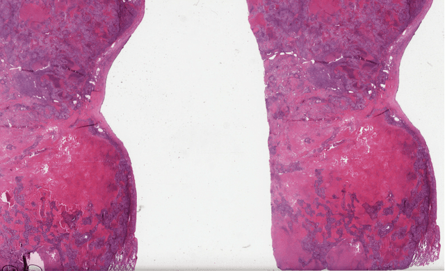 Figure 3 for Discovering Clinically Meaningful Shape Features for the Analysis of Tumor Pathology Images