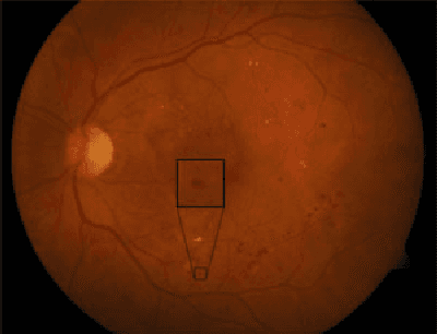 Figure 1 for An Ensemble-based System for Microaneurysm Detection and Diabetic Retinopathy Grading