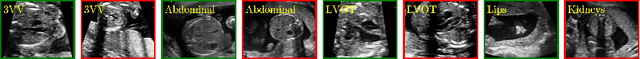 Figure 1 for Representation Disentanglement for Multi-task Learning with application to Fetal Ultrasound