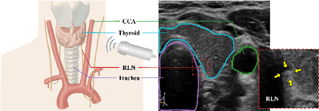 Figure 1 for Localizing the Recurrent Laryngeal Nerve via Ultrasound with a Bayesian Shape Framework