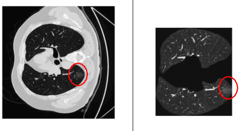 Figure 2 for Automatic Deep Learning System for COVID-19 Infection Quantification in chest CT
