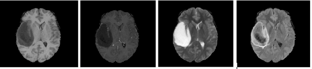 Figure 1 for Brain Tumor Segmentation Based on Refined Fully Convolutional Neural Networks with A Hierarchical Dice Loss