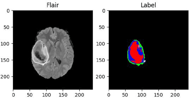 Figure 3 for Brain Tumor Segmentation Based on Refined Fully Convolutional Neural Networks with A Hierarchical Dice Loss