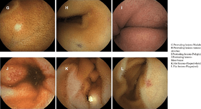 Figure 4 for Application of Structural Similarity Analysis of Visually Salient Areas and Hierarchical Clustering in the Screening of Similar Wireless Capsule Endoscopic Images