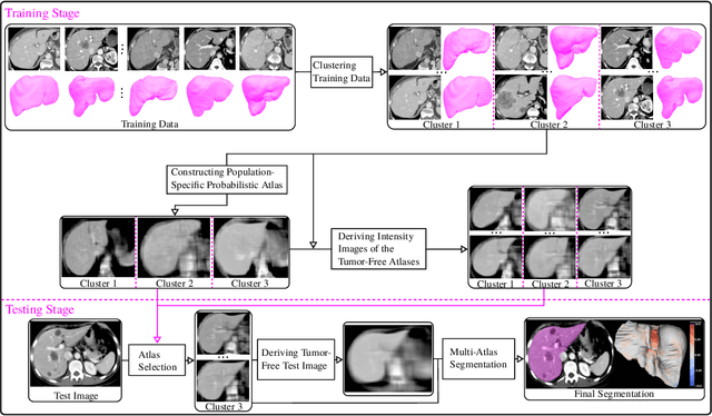 Figure 3 for Multi-Slice Low-Rank Tensor Decomposition Based Multi-Atlas Segmentation: Application to Automatic Pathological Liver CT Segmentation