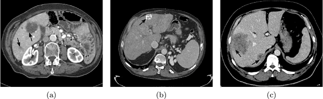 Figure 1 for Multi-Slice Low-Rank Tensor Decomposition Based Multi-Atlas Segmentation: Application to Automatic Pathological Liver CT Segmentation