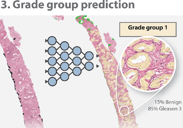 Figure 1 for Automated Gleason Grading of Prostate Biopsies using Deep Learning