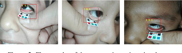 Figure 3 for Portable system for the prediction of anemia based on the ocular conjunctiva using Artificial Intelligence