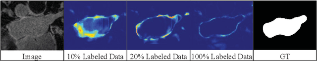 Figure 1 for Semi-supervised Left Atrium Segmentation with Mutual Consistency Training