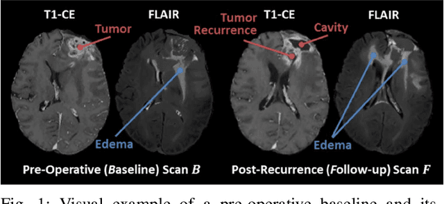 Figure 1 for The Brain Tumor Sequence Registration Challenge: Establishing Correspondence between Pre-Operative and Follow-up MRI scans of diffuse glioma patients