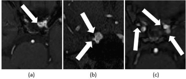 Figure 2 for An Automatic Detection Method Of Cerebral Aneurysms In Time-Of-Flight Magnetic Resonance Angiography Images Based On Attention 3D U-Net