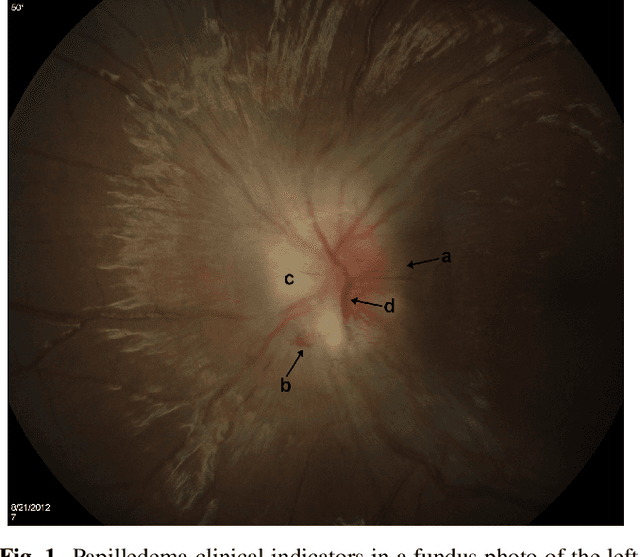 Figure 1 for Automating Detection of Papilledema in Pediatric Fundus Images with Explainable Machine Learning