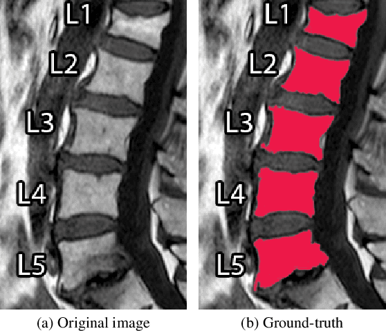 Figure 1 for BGrowth: an efficient approach for the segmentation of vertebral compression fractures in magnetic resonance imaging