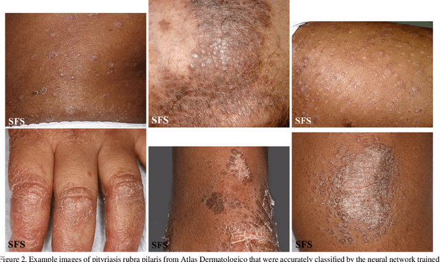 Figure 4 for Evaluating Deep Neural Networks Trained on Clinical Images in Dermatology with the Fitzpatrick 17k Dataset
