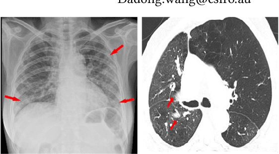 Figure 1 for CNN-based Local Vision Transformer for COVID-19 Diagnosis