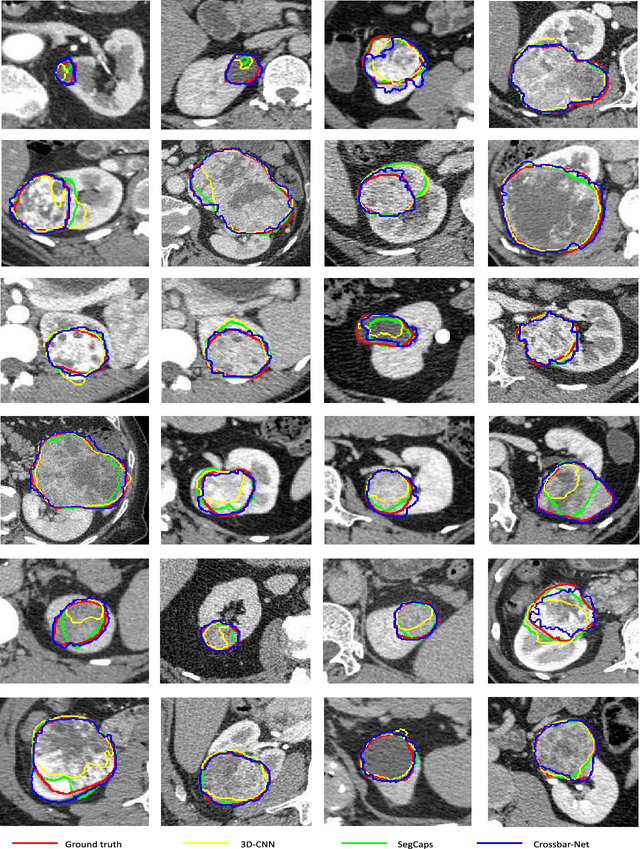 Figure 4 for Crossbar-Net: A Novel Convolutional Network for Kidney Tumor Segmentation in CT Images