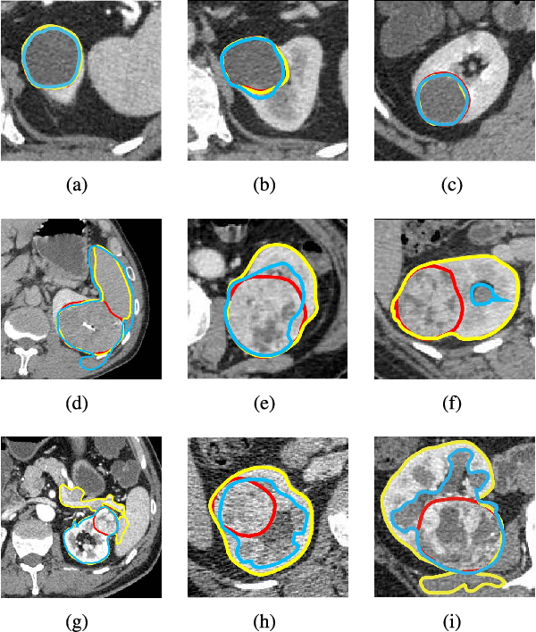 Figure 1 for Crossbar-Net: A Novel Convolutional Network for Kidney Tumor Segmentation in CT Images