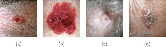 Figure 4 for Artificial Intelligence-Based Image Classification for Diagnosis of Skin Cancer: Challenges and Opportunities