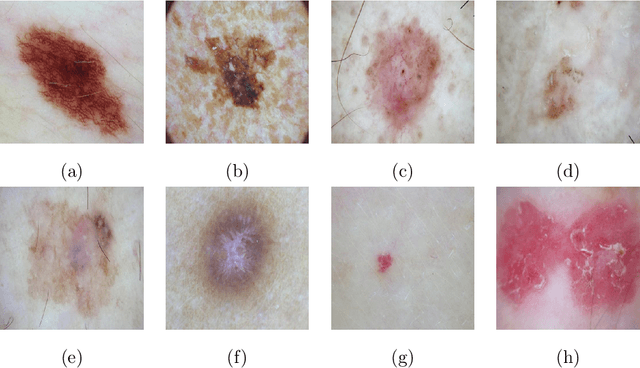 Figure 1 for Artificial Intelligence for Diagnosis of Skin Cancer: Challenges and Opportunities