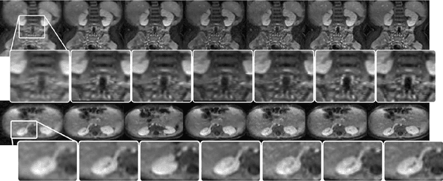 Figure 2 for Deep Generative Adversarial Networks for Compressed Sensing Automates MRI
