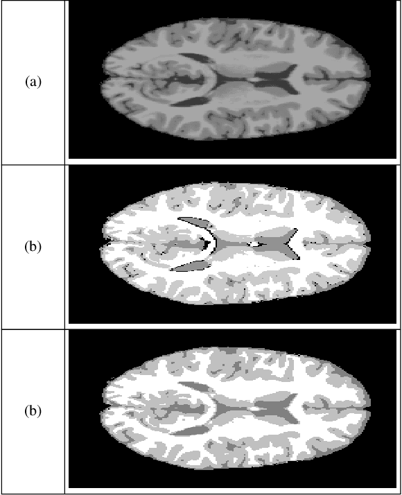 Figure 2 for hidden markov random fields and cuckoo search method for medical image segmentation